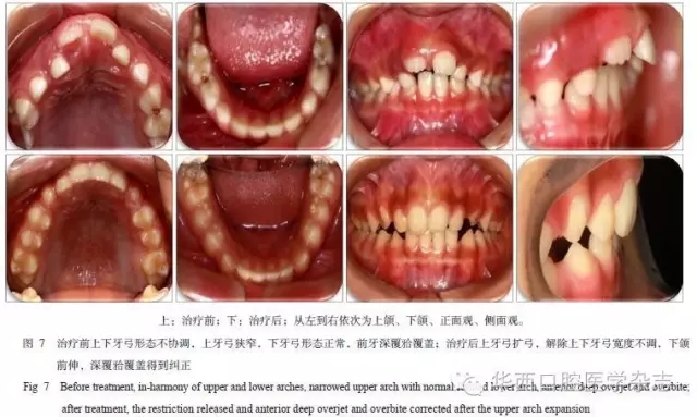 牙弓/牙槽骨弓的塑形矫治——基于牙弓形态发育不良的