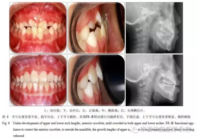 牙弓/牙槽骨弓的塑形矫治——基于牙弓形态发育不良的