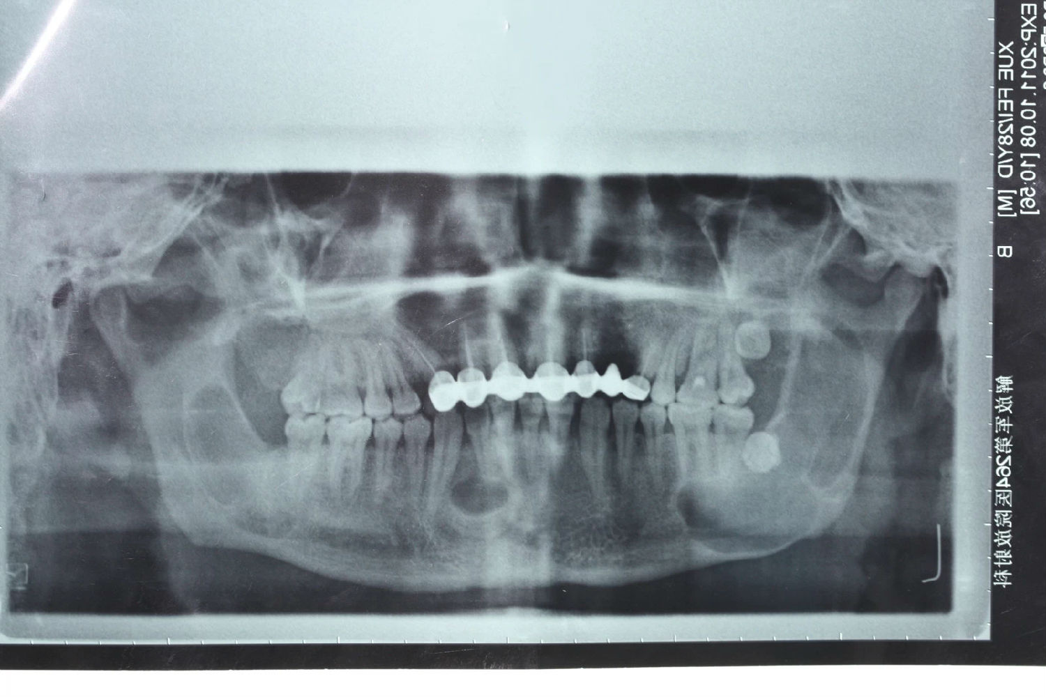 3.2.6 粘液瘤-口腔颌面肿瘤手术-医学