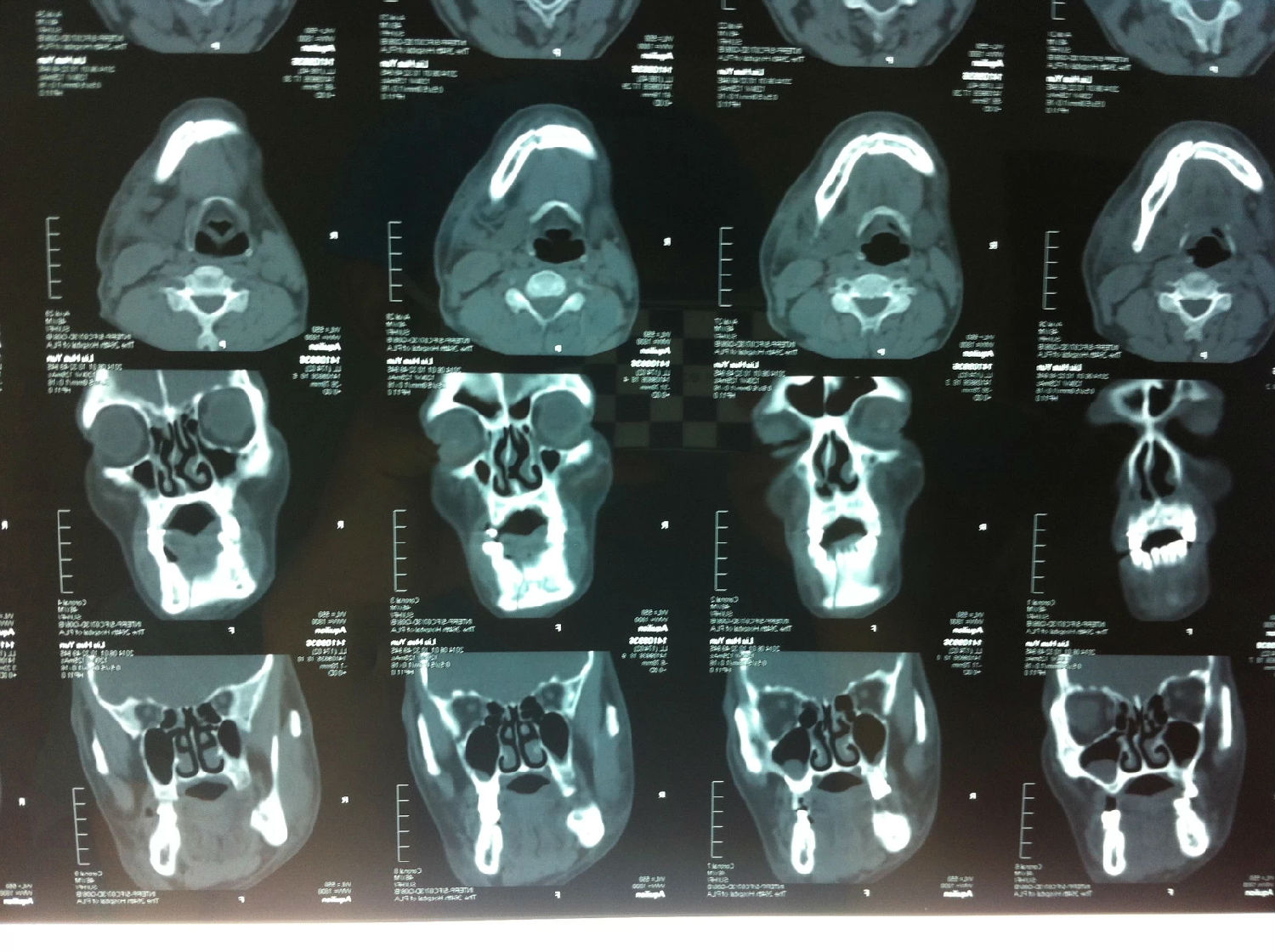 第一节 蜂窝组织炎与脓肿-颌面颈部疾病影像学图鉴-医学