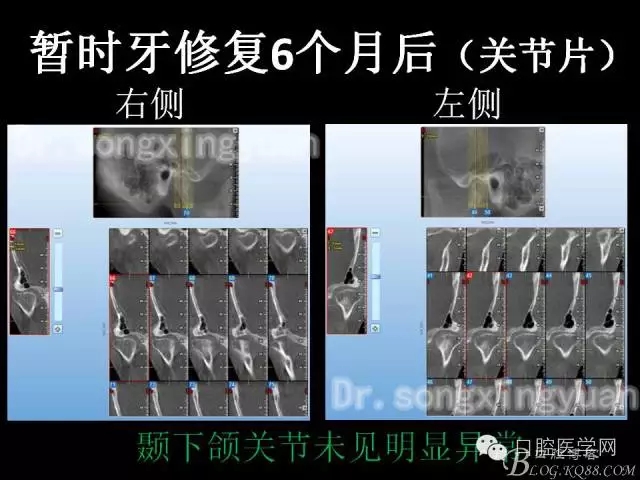 种植牙全口咬合重建