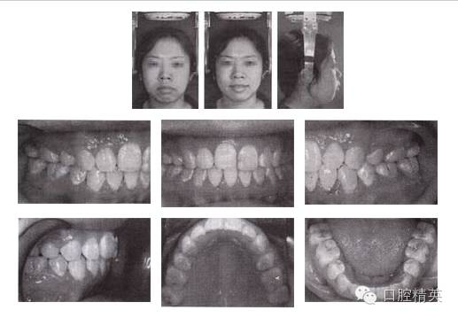 拔牙矫治开颌伴前突