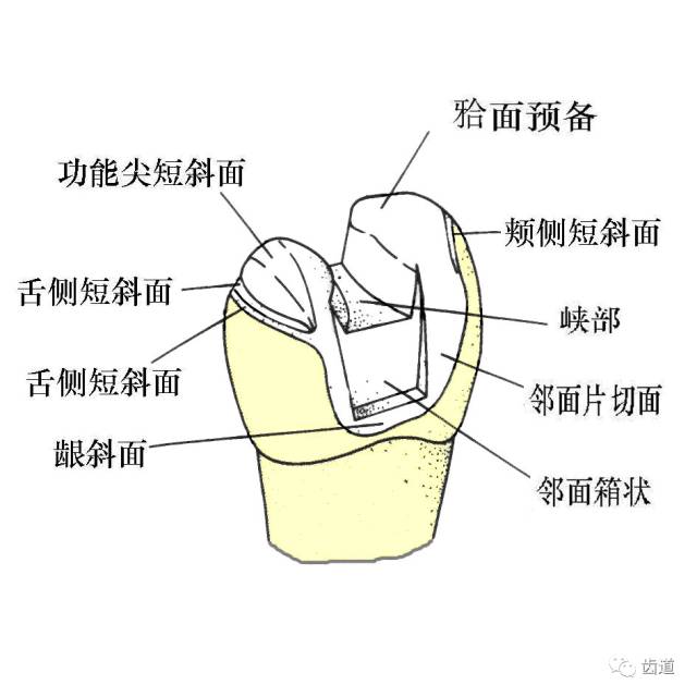 高嵌体的牙体预备步骤