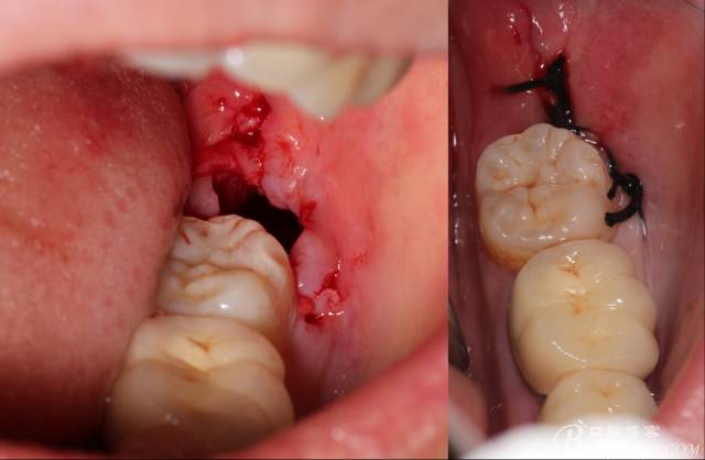 【征文大赛】干货:印章法速补左下第二磨牙后拨除智齿