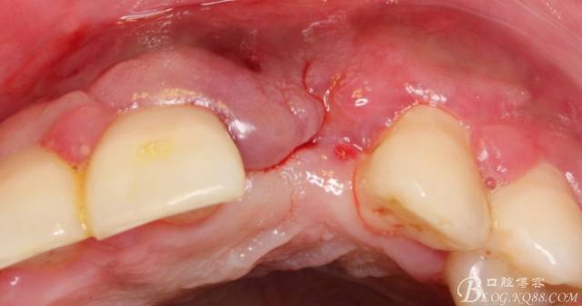 【征文大赛】一例上前牙种植失败病例的补救--梁光强
