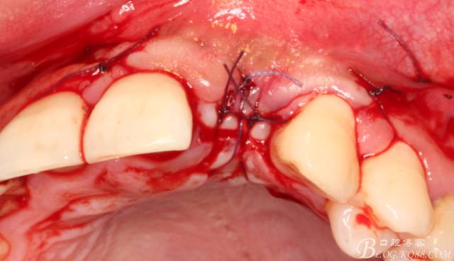 【征文大赛】一例上前牙种植失败病例的补救--梁光强