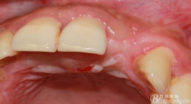 【征文大赛】一例上前牙种植失败病例的补救--梁光强
