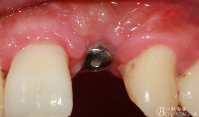 【征文大赛】一例上前牙种植失败病例的补救--梁光强