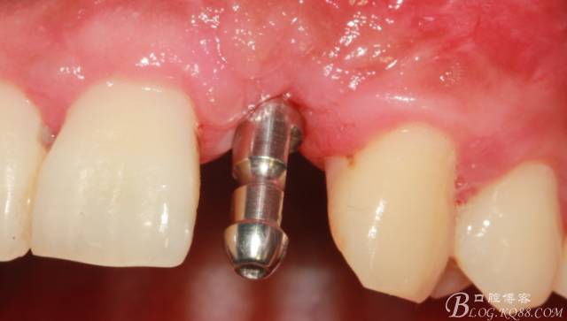 【征文大赛】一例上前牙种植失败病例的补救--梁光强