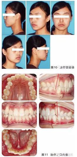 两例舌侧拔牙矫正病例|正畸矫正|陕西嘉友科贸有限公司