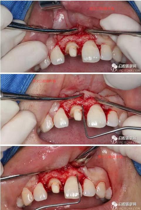 翻瓣 见11釉牙骨质界存在,牙槽嵴顶到釉牙骨质界不足2mm.