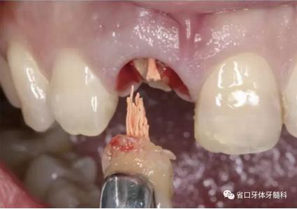 右上前牙即刻种植即刻修复1例