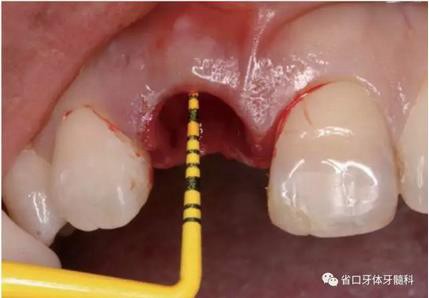 右上前牙即刻种植即刻修复1例