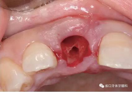 右上前牙即刻种植即刻修复1例