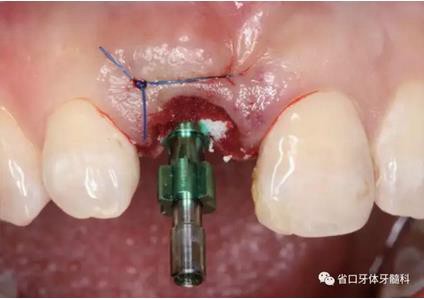 右上前牙即刻种植即刻修复1例
