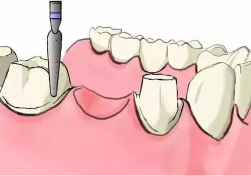 图解：种牙与镶牙的区别，缺牙的赶紧看.png