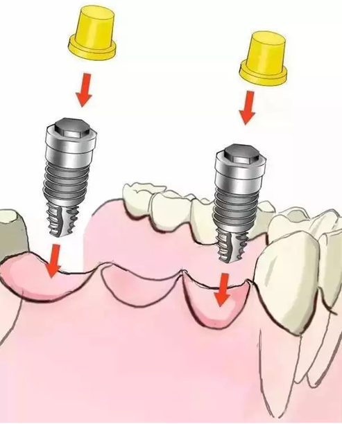 图解：种牙与镶牙的区别，缺牙的赶紧看.png