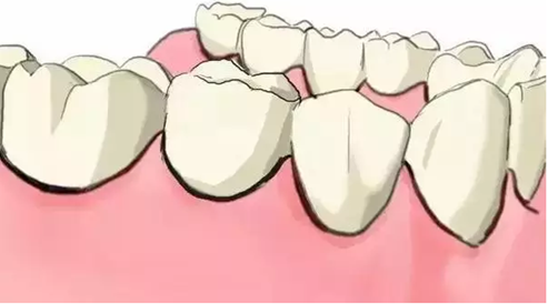 图解：种牙与镶牙的区别，缺牙的赶紧看.png