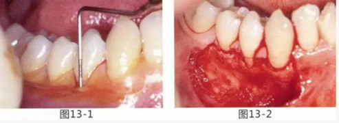 FGG法增大附着龈及根面覆盖【牙龈－牙槽黏膜的问题】.png