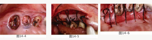 FGG法增大附着龈及根面覆盖【牙龈－牙槽黏膜的问题】.png