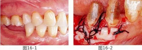 FGG法增大附着龈及根面覆盖【牙龈－牙槽黏膜的问题】.png