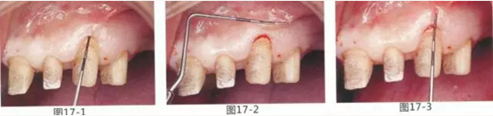 FGG法增大附着龈及根面覆盖【牙龈－牙槽黏膜的问题】.png