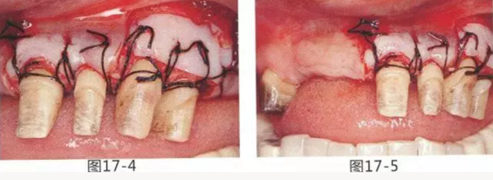 FGG法增大附着龈及根面覆盖【牙龈－牙槽黏膜的问题】.png