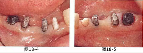 FGG法增大附着龈及根面覆盖【牙龈－牙槽黏膜的问题】.png