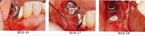 FGG法增大附着龈及根面覆盖【牙龈－牙槽黏膜的问题】.png