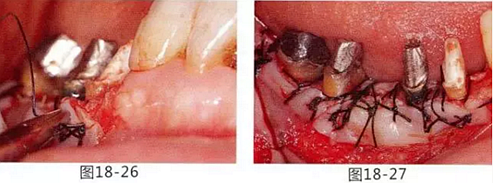 FGG法增大附着龈及根面覆盖【牙龈－牙槽黏膜的问题】.png
