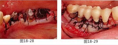 FGG法增大附着龈及根面覆盖【牙龈－牙槽黏膜的问题】.png