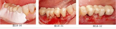 FGG法增大附着龈及根面覆盖【牙龈－牙槽黏膜的问题】.png