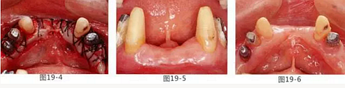 FGG法增大附着龈及根面覆盖【牙龈－牙槽黏膜的问题】.png