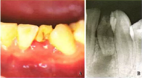 下颌侧切牙Ⅲ型牙内陷1例.png