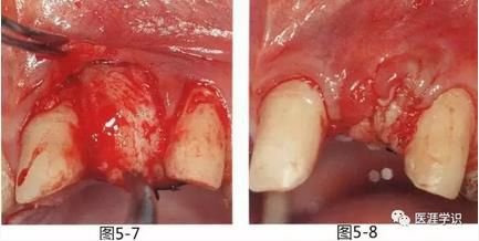【缺失部牙槽嵴的形态异常】拔牙同时进行的牙槽嵴保存术