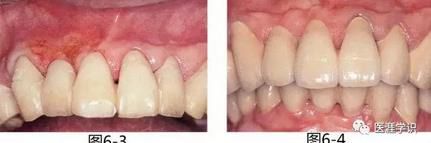 【缺失部牙槽嵴的形态异常】拔牙同时进行的牙槽嵴保存术