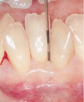 【牙位异常】影响到牙周组织的牙位异常