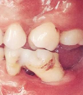 3【牙位异常】影响到牙周组织的牙位异常