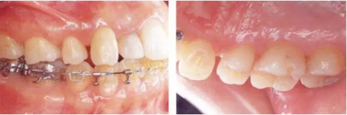 【牙位异常】牙位异常时的牙周外科处理-接触点异常（一）.png