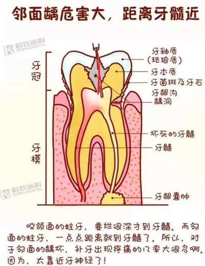 牙缝间的黑线是邻面龋，还一坏坏俩，巧用它帮你渡过一“劫”