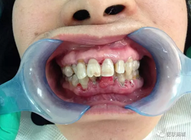 慢性牙周炎伴牙龈瘤女性患者一例