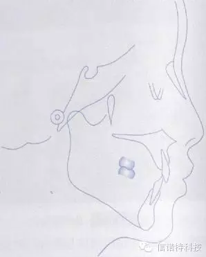常用X线头影测量的标志点