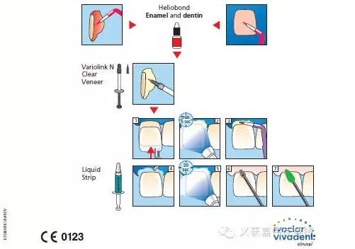 义获嘉贴面粘接的操作步骤！