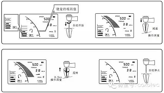 C-SMART-I+根管治疗仪操作方法