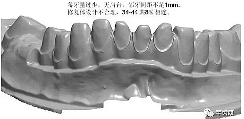 影响全瓷牙冠裂的因素有哪些？