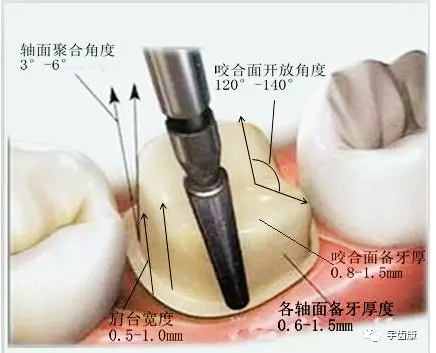 影响全瓷牙冠裂的因素有哪些？