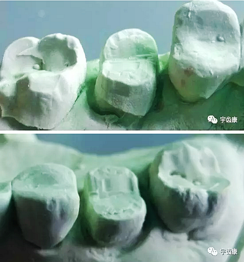 影响全瓷牙冠裂的因素有哪些？