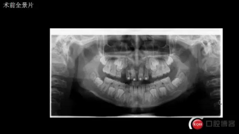 CBCT导航下多生牙拔除，混合牙列期矫正思考！