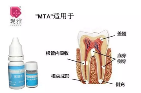 “观雅”MTA修补侧穿一例