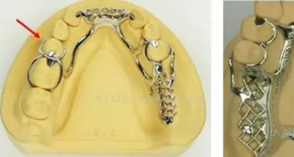 游离端缺失末端基牙十大推荐铸造卡环|义齿技术|陕西